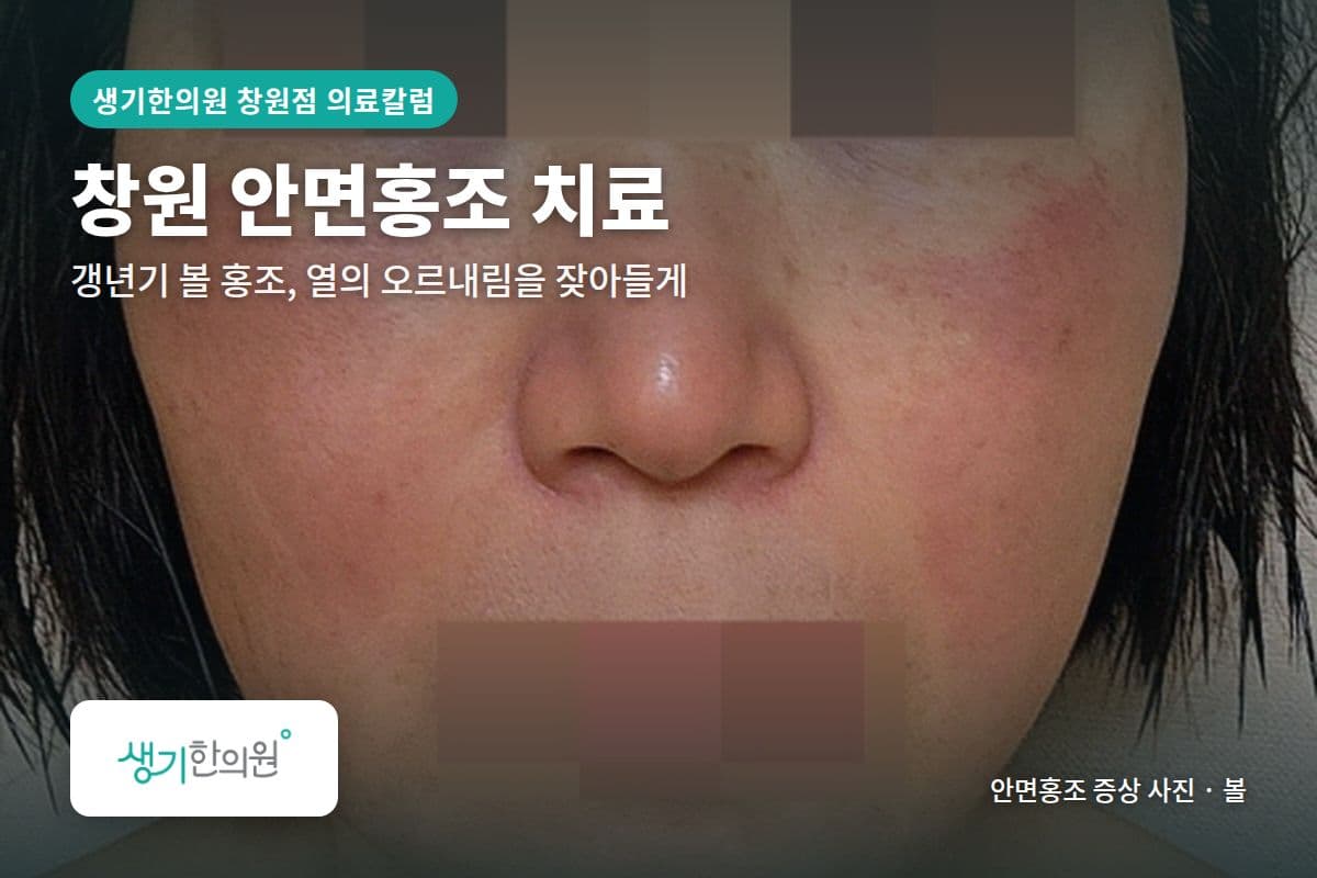 볼 안면홍조 증상 사진과 문구 「창원 안면홍조 치료, 갱년기 볼 홍조, 열의 오르내림을 잦아들게 · 생기한의원 창원점」
