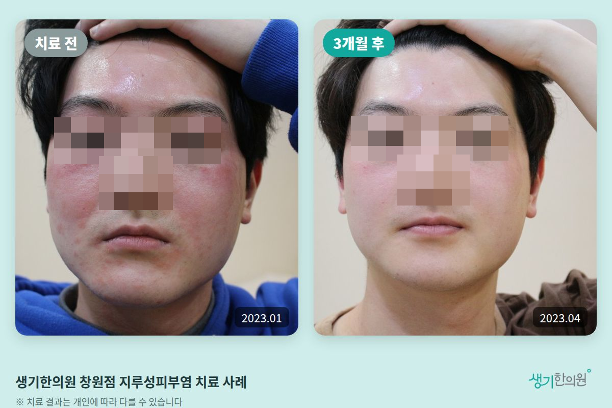 생기한의원 창원점 지루성피부염 치료 전(2023.01)과 3개월 후(2023.04) 비교 사진