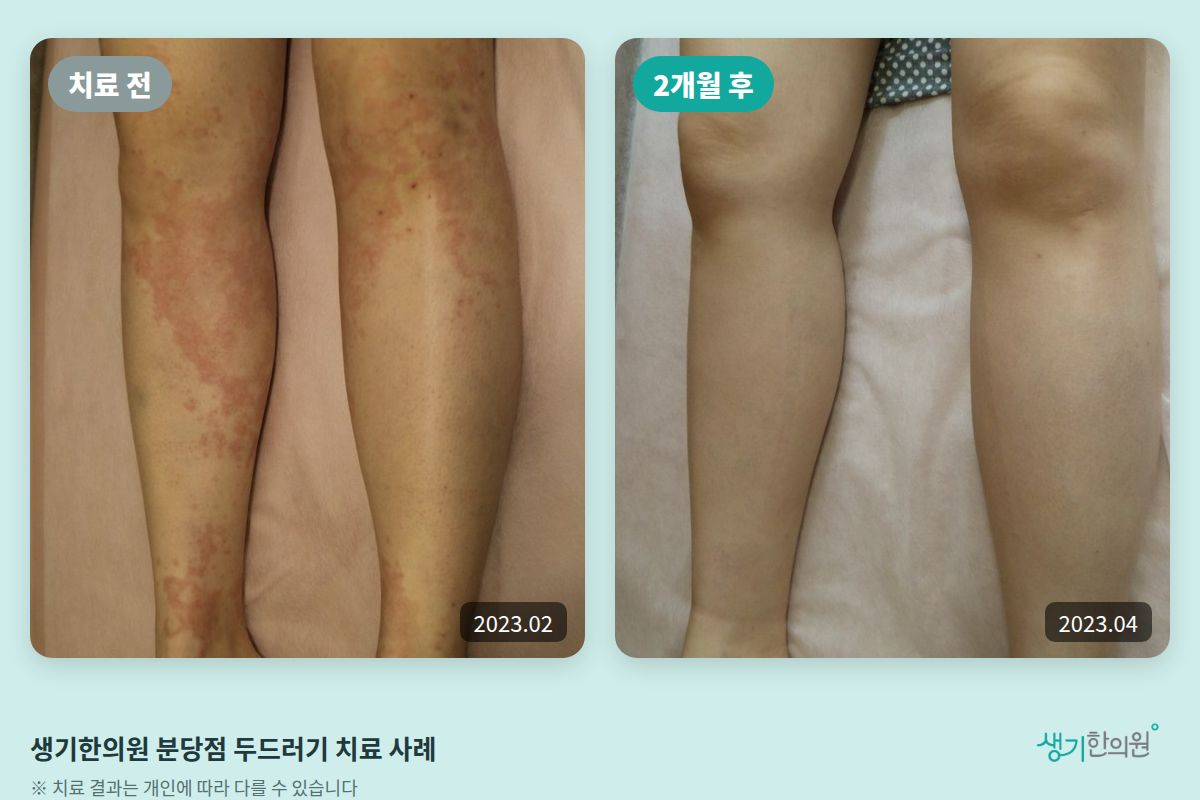 생기한의원 분당점 두드러기 치료 전(2023.02)과 2개월 후(2023.04) 비교 사진
