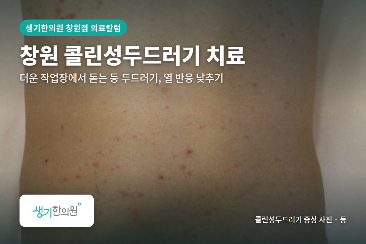 등 콜린성두드러기 증상 사진과 문구 「창원 콜린성두드러기 치료, 더운 작업장에서 돋는 등 두드러기, 열 반응 낮추기 · 생기한의원 창원점」