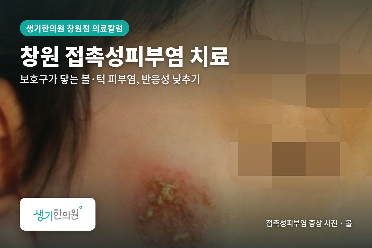 볼 접촉성피부염 증상 사진과 문구 「창원 접촉성피부염 치료, 보호구가 닿는 볼·턱 피부염, 반응성 낮추기 · 생기한의원 창원점」