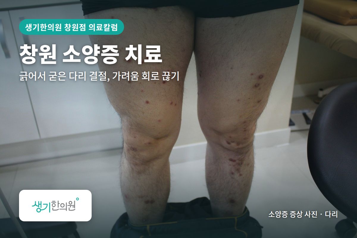다리 소양증 증상 사진과 문구 「창원 소양증 치료, 긁어서 굳은 다리 결절, 가려움 회로 끊기 · 생기한의원 창원점」