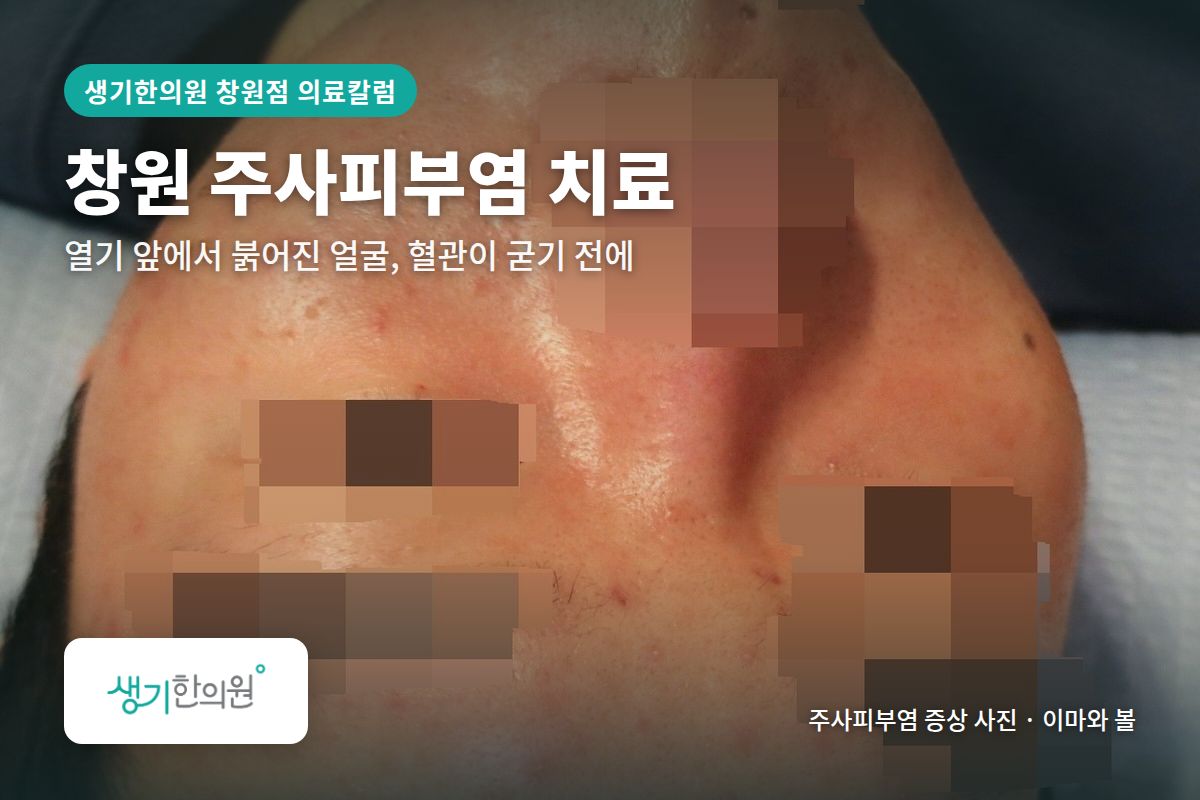 이마와 볼 주사피부염 증상 사진과 문구 「창원 주사피부염 치료, 열기 앞에서 붉어진 얼굴, 혈관이 굳기 전에 · 생기한의원 창원점」
