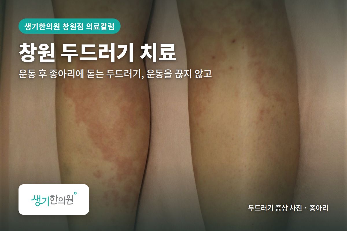 종아리 두드러기 증상 사진과 문구 「창원 두드러기 치료, 운동 후 종아리에 돋는 두드러기, 운동을 끊지 않고 · 생기한의원 창원점」